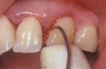 歯と歯ぐきの境目のクリーニング