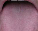 口臭の原因のひとつ舌苔